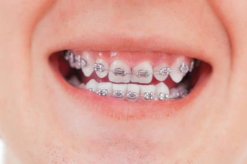 北京牙齿单冠修复的报价需要多少钱合理(2023北京牙齿单冠修复价格范围：4161-5992元)