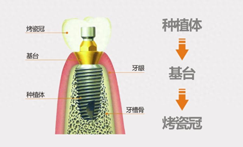 2024重庆韩国百康口腔医院种植牙服务口碑排名
