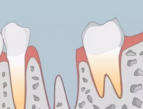 韩国implant和登腾哪个是更好的植体选择？一个详尽的比较解析