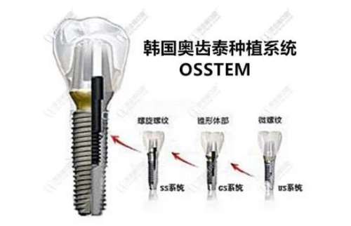 以色列和韩国牙种哪家强？全球种植牙价格解析