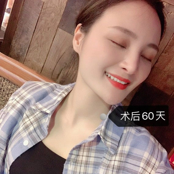 冷光美白牙齿案例效果图