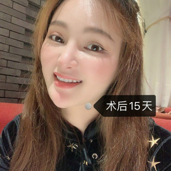 冷光美白牙齿案例效果图