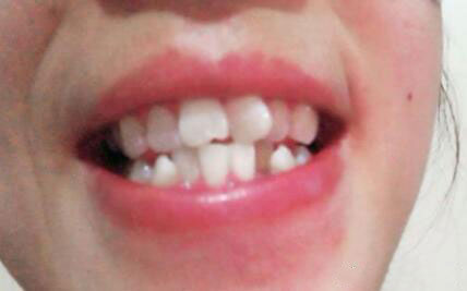 陶林月牙齿矫正术前照片