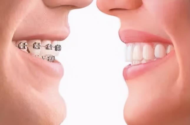 矫正牙齿一般是什么价格？矫正牙齿价格大概多少？