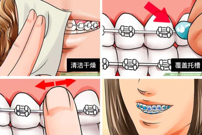 牙齿矫正后是否会引起牙龈萎缩？如何处理牙齿矫正后的牙龈萎缩问题？