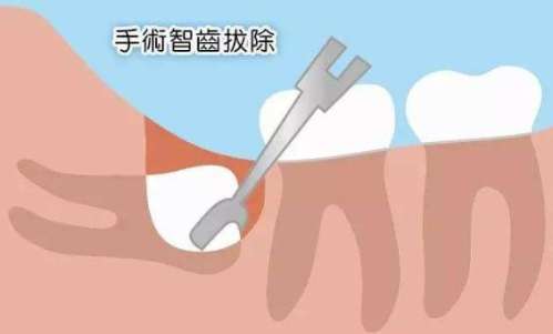 龅牙凸嘴矫正的解决方法与西安专家推荐