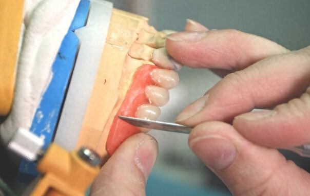 种牙护理推荐：解决老年人骨量不足翼颧穿孔
