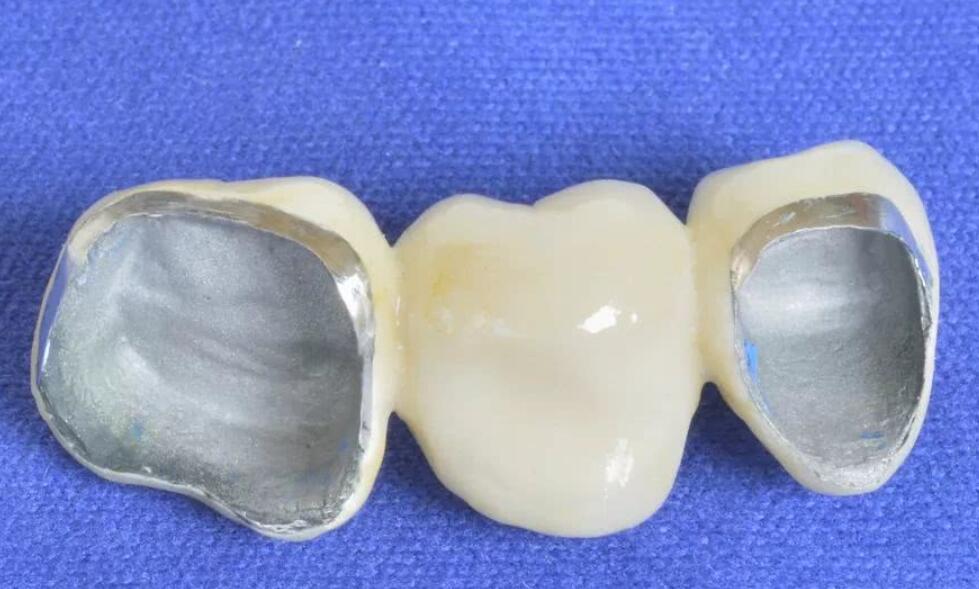 郑州哪家口腔诊所能为你提供专业的种植牙治疗？